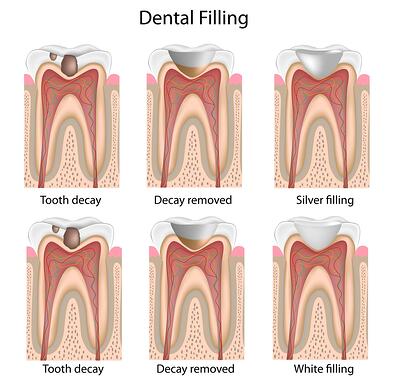 Dental Filling 4 